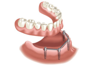 implantologia1_centrodenateleilsorriso-eu