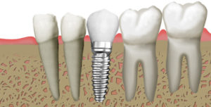 implantologia2_centrodenateleilsorriso-eu